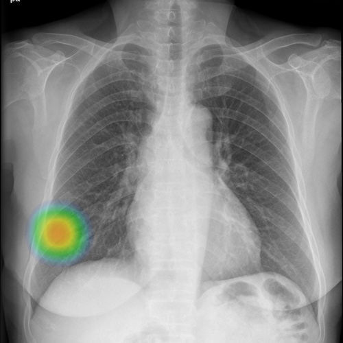 Röntgensoftware - INSIGHT CXR - Lunit - Sensor / mit künstlicher Intelligenz / medizinisch