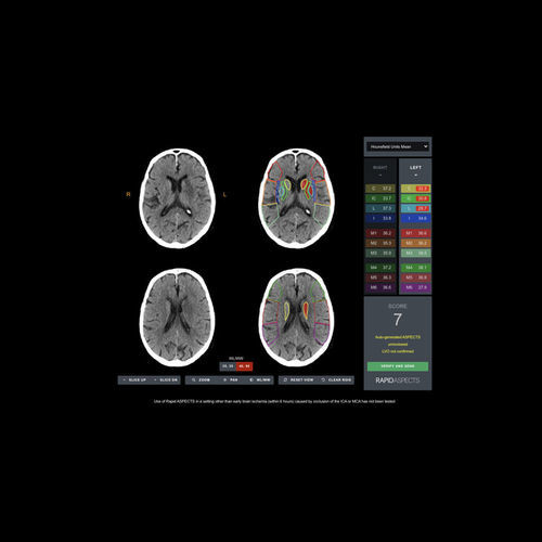 Software für Schlaganfalldiagnostik - ASPECTS - RapidAI - Erfassung / Bewertung / Bestätigung