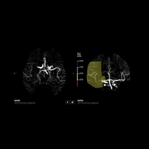 Medizinische Software - CTA - RapidAI - Computertomographie / Angiographie / Umform