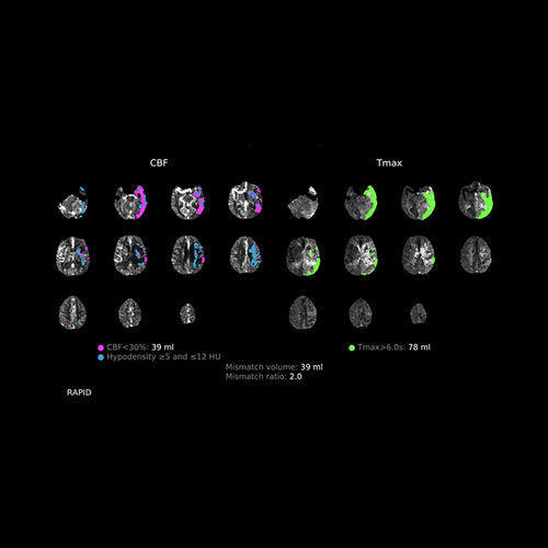 Medizinische Software - CTP - RapidAI - für Kliniken / Computertomographie / Analyse