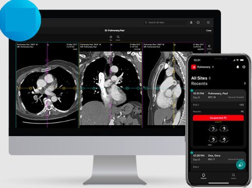 Viewer-Software - PE - RapidAI - Diagnose / Umform / medizinisch