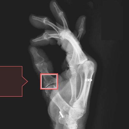 Software zur Frakturerkennung - RBfracture™ - Radiobotics - medizinisch / Notfall / für Radiologie