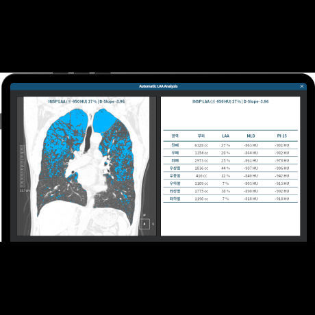 Analysesoftware - LCS PLUS - Coreline - zur Früherkennung von Lungenkrebs / medizinisch / Computertomographie