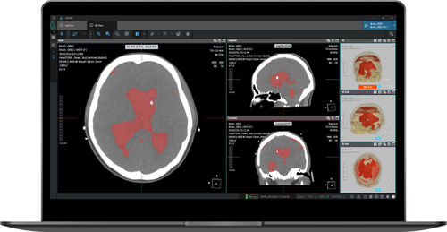 Medizinische Software - NeuroCAD - Coreline - Notfall / Computertomographie / Analyse