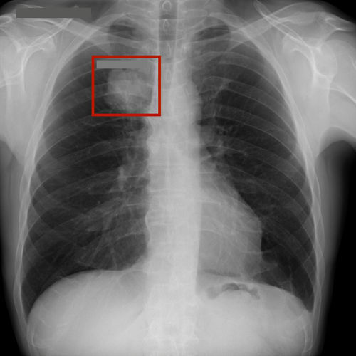 Bildanalyse-Software - RAYVOLVE - AZmed - mit künstlicher Intelligenz / für Radiologie / Brust