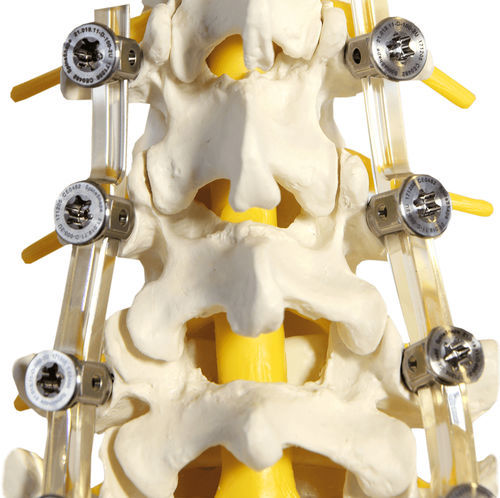 Stabilisierungssystem für Osteosynthese / LWS - SpineShape System IV - SpineSave - dorsaler Zugang / für Erwachsene