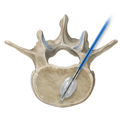 Vertebroplastie-System / Ballonkatheter - Osteo-Site®  - IZI Medical - Nadel / Fräser / für perkutane Vertebroplastie