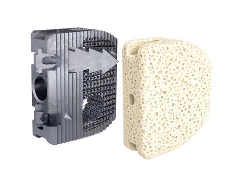 HWS-Zwischenwirbelimplantat - Monza  - Clover Next - ventraler Zugang / Titan / 3D-Druck