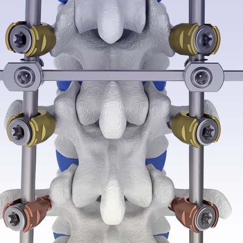 Thorako-lumbales Stabilisierungssystem für Osteosynthese - VENUS® - HumanTech Dental - dorsaler Zugang / für Erwachsene