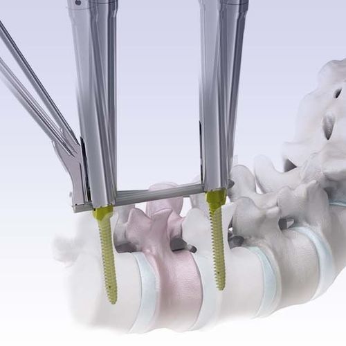 Minimalinvasives Pedikelschrauben-Positionierungssystem - VENUS®mini 2.0 - HumanTech Dental
