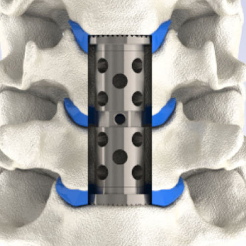 Korpektomie-Wirbelkörperprothese / HWS - LEANDER® - HumanTech Dental - erweiterbar