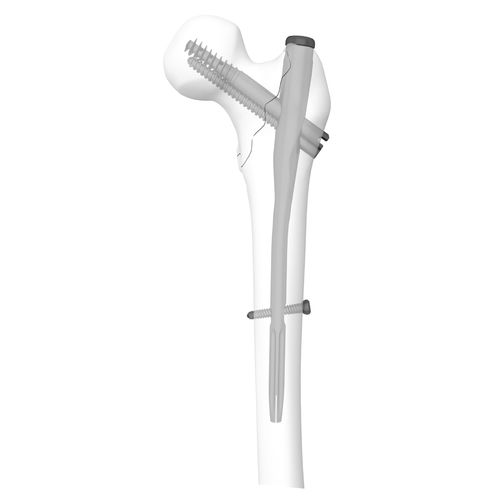 Marknagel für Oberschenkelknochen - 305030 series - Boneunion Medical - mit proximaler Fixierung / rechts / links