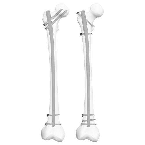 Marknagel für Oberschenkelknochen - 305009  - Boneunion Medical - mit proximaler Fixierung / mit distaler Fixierung / rechts