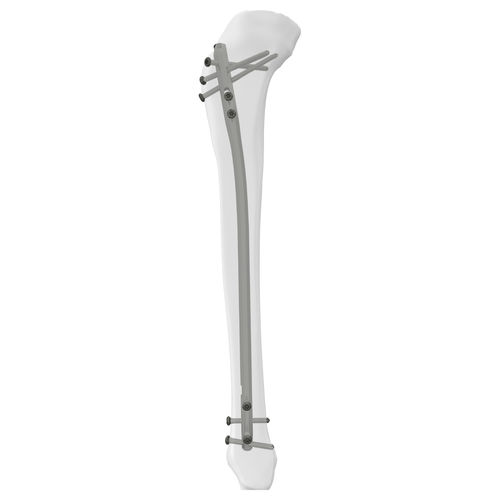 Marknagel / für Schienbein - 305014 series - Boneunion Medical - mit proximaler Fixierung / mit distaler Fixierung / rechts