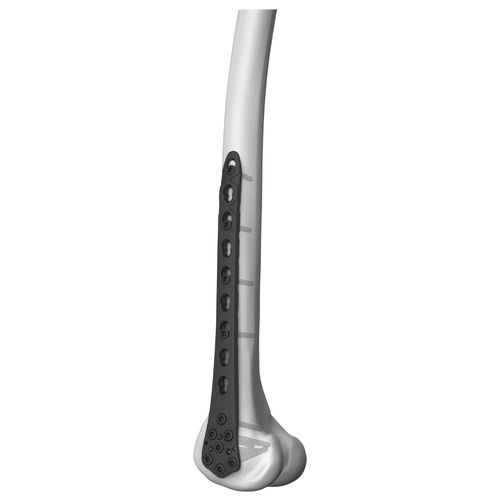 Kompressionsplatte für Oberschenkelknochen - 301014 series - Boneunion Medical - distal / seitlich / mit Verriegelung