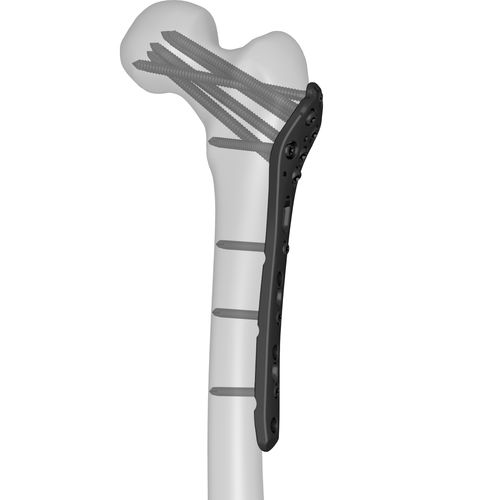 Kompressionsplatte für Oberschenkelknochen - 301040 series - Boneunion Medical - proximal / mit Verriegelung / Titan