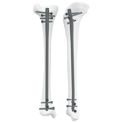 Marknagel / für Schienbein - 305050 series - Boneunion Medical - mit proximaler Fixierung / mit distaler Fixierung / rechts