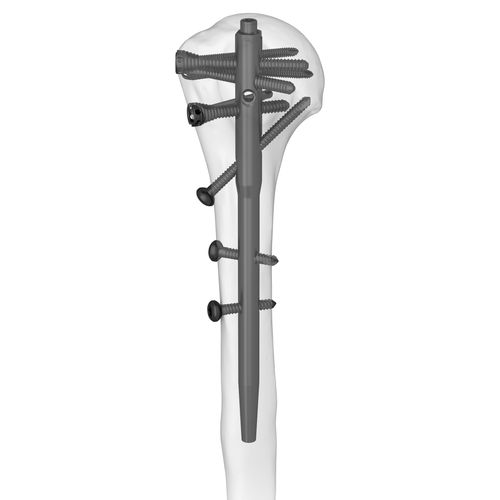 Marknagel / Humerus - 305077 series - Boneunion Medical - mit proximaler Fixierung / mit distaler Fixierung / rechts
