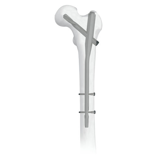 Marknagel für Oberschenkelknochen - 30500 series - Boneunion Medical - mit proximaler Fixierung / Titan