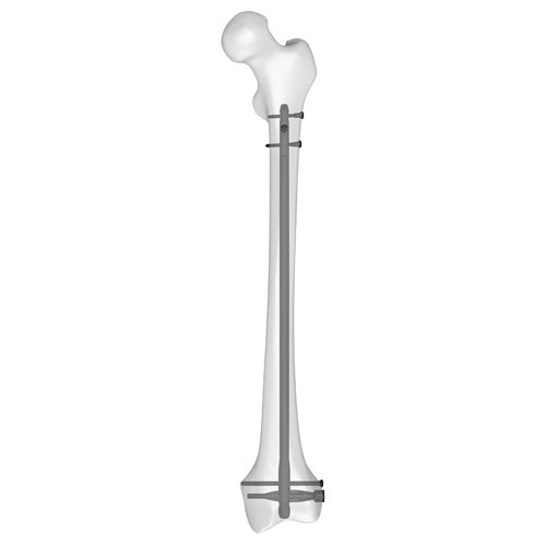 Marknagel für Oberschenkelknochen - 30510 series - Boneunion Medical - mit distaler Fixierung / rechts / links