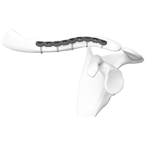 Kompressionsplatte für Schlüsselbein - 301249 series - Boneunion Medical - distal / mit Verriegelung / Titan