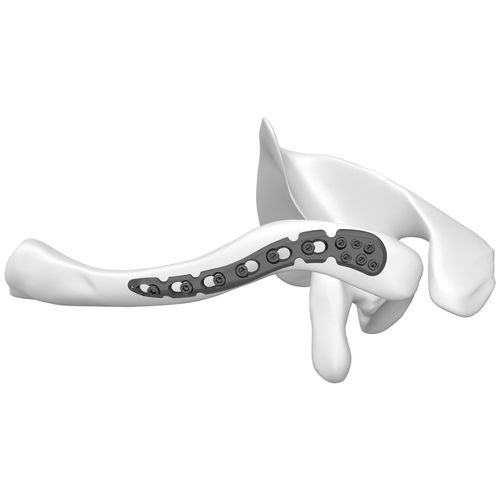 Kompressionsplatte für Schlüsselbein - 301055 series - Boneunion Medical - distal / mit Verriegelung / Titan