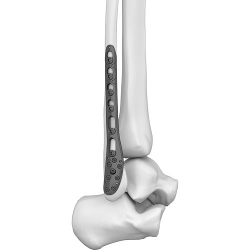 Kompressionsplatte für Fibula - 301019 series - Boneunion Medical - distal / mit Verriegelung / Titan