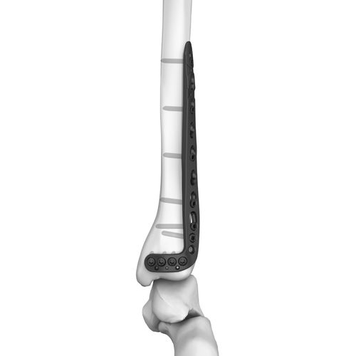Kompressionsplatte für Tibia - 301026 series - Boneunion Medical - distal / seitlich / mit Verriegelung
