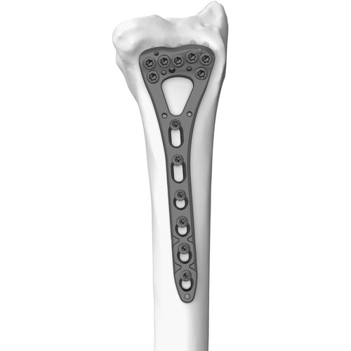 Kompressionsplatte für Radius - 301077 series - Boneunion Medical - distal / mit Verriegelung / Titan