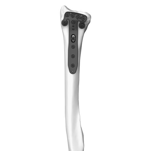Kompressionsplatte für Radius - 30104 series - Boneunion Medical - distal / mit Verriegelung / Titan