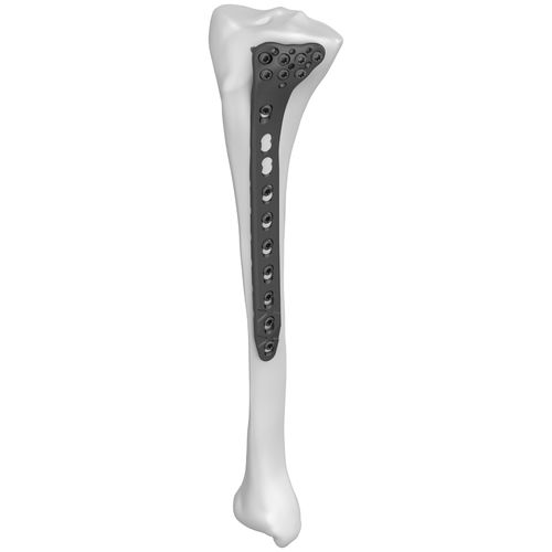 Kompressionsplatte für Tibia - 301022 series - Boneunion Medical - proximal / seitlich / mit Verriegelung