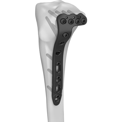 Kompressionsplatte für Tibia - 301023 series - Boneunion Medical - proximal / seitlich / mit Verriegelung