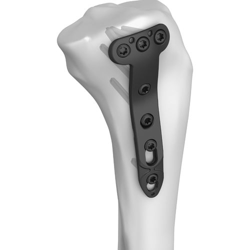 Kompressionsplatte für Tibia - 301005 series - Boneunion Medical - proximal / medial / mit Verriegelung