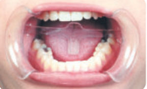 Wangenretraktor - 2060A  - premium pluspoland - Zunge / Dental / zum Einmalgebrauch
