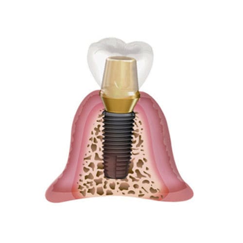 Zylindrisches Zahnimplantat - chengdu  kangjie medical instrument Co.,Ltd - Titan / konisch / gerade