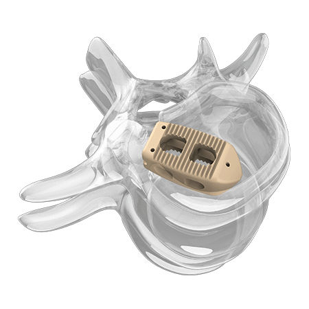 LWS-Zwischenwirbelimplantat - 4000 series - Aplus Biotechnology - dorsaler Zugang / aus PEEK