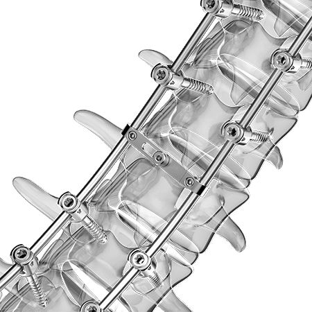 Thorako-lumbales Stabilisierungssystem für Osteosynthese - Aplus Biotechnology - dorsaler Zugang / für Erwachsene