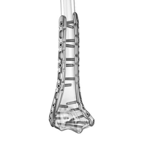 Kompressionsplatte für Humerus - 0202-1400:1401 series - Aplus Biotechnology - distal / seitlich / medial
