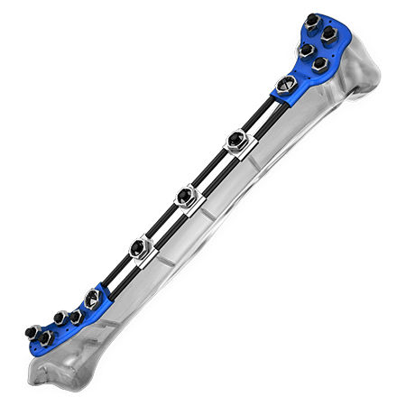 Fixateur externe / für Tibia - Aplus Biotechnology - rohrförmig / für Kinder