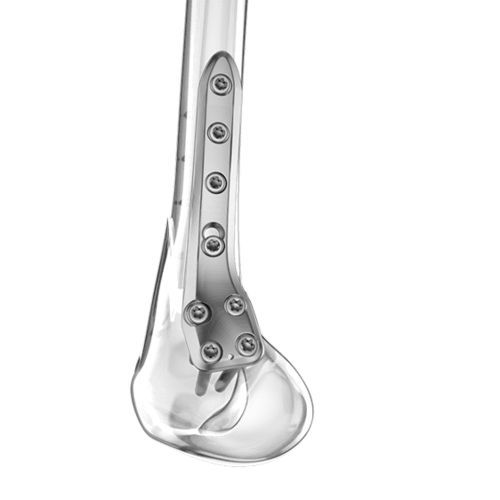 Osteotomieplatte für Oberschenkelknochen - Aplus Biotechnology - distal / mit Verriegelung / Titan