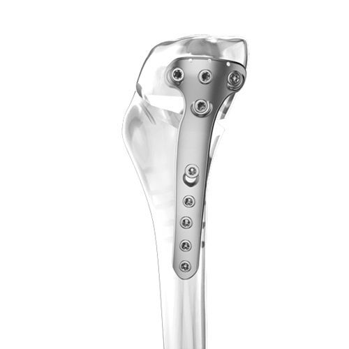 Osteotomieplatte für Tibia - Aplus Biotechnology - proximal / mit Verriegelung / Titan