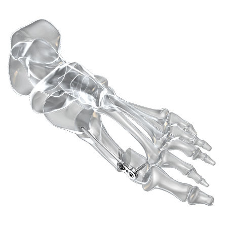 Osteotomieplatte für Hallux Valgus - 1600-1320-01 - Aplus Biotechnology - distal / mit Verriegelung / Titan