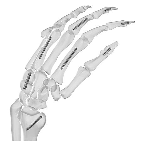 Arthrodeseschraube für Handwurzelknochen - Aplus Biotechnology - für Fingerglied / ohne Kopf