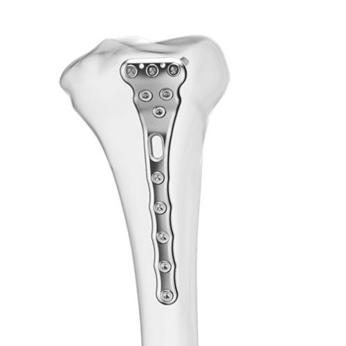 Kompressionsplatte für Tibia - Aplus Biotechnology - proximal / posteromedial / mit Verriegelung