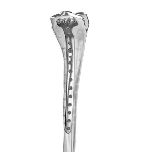 Kompressionsplatte für Tibia - Aplus Biotechnology - proximal / medial / mit Verriegelung
