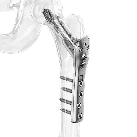 Kompressionsplatte für Trochanter - 2500-0020:0021 series - Aplus Biotechnology - für Hüftkopf / proximal / mit Verriegelung
