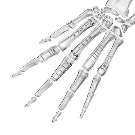 Kompressionsplatte für Fingerglied - 1600 series - Aplus Biotechnology - für Fuß / für kleine Knochenfragmente / für Mittelhandknochen