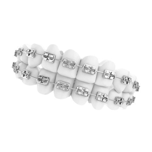 Orthodontie Bracket / Metall - ALA-BS - Alamere Medical Corporation - ästhetisch