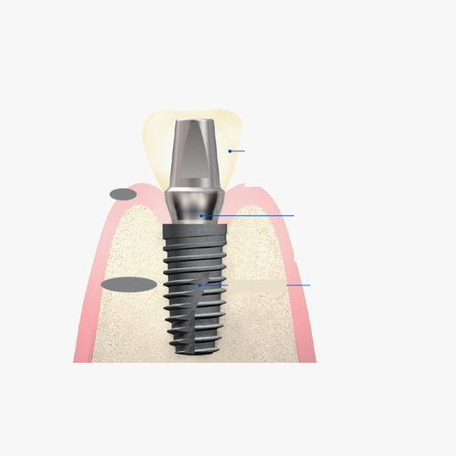 Implantat-Abutment / Titan - Snucone Co.,Ltd - mit Innenverbindung / gerade / zementiert