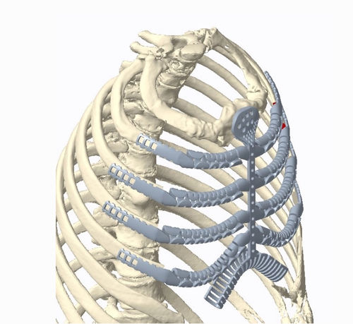 Rippenprothese zum Wiederaufbau nach Knochensarkom-Resektion - Osteobionix